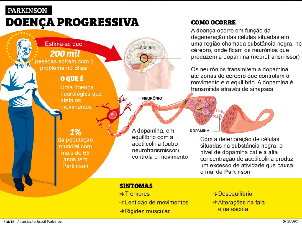 Cirurgia cerebral que ameniza sintomas do Parkinson é ofertada pelo SUS