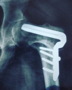 Família pede ajuda para arrecadar recursos para cirurgia de adolescente
